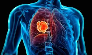 nódulos pulmonares