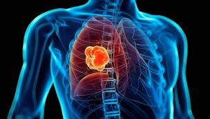 nódulos pulmonares