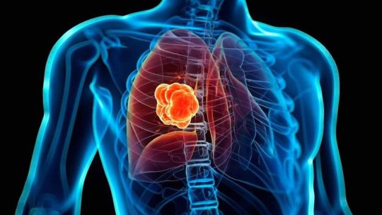 Qué son los nódulos pulmonares, la lesión por la que será operado el papa León XIV