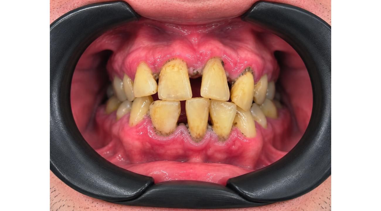 ¿Se te mueven los dientes y pensás que es normal?