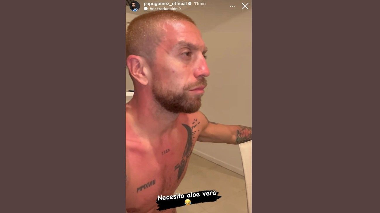 Papu Gómez quemado