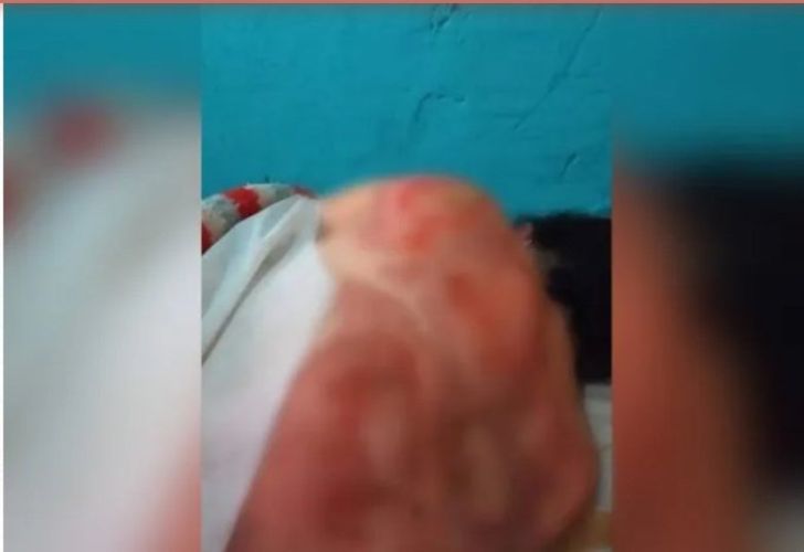 Una mujer fue quemada con ácido en La Matanza.